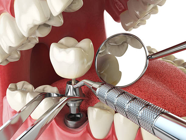 Best Emergency Wisdom Teeth Removal in Chesaning, MI